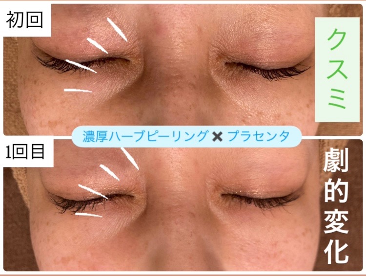 1回の施術でお顔のクスミが...😳✨