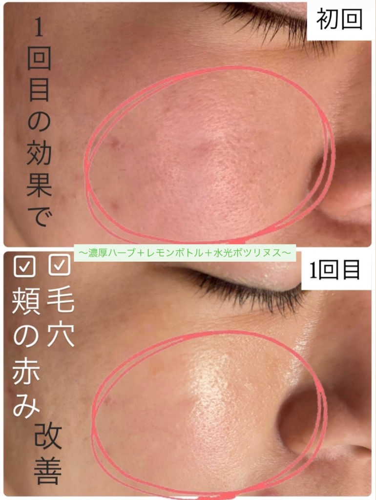 毛穴の開き・頬の赤み改善◎