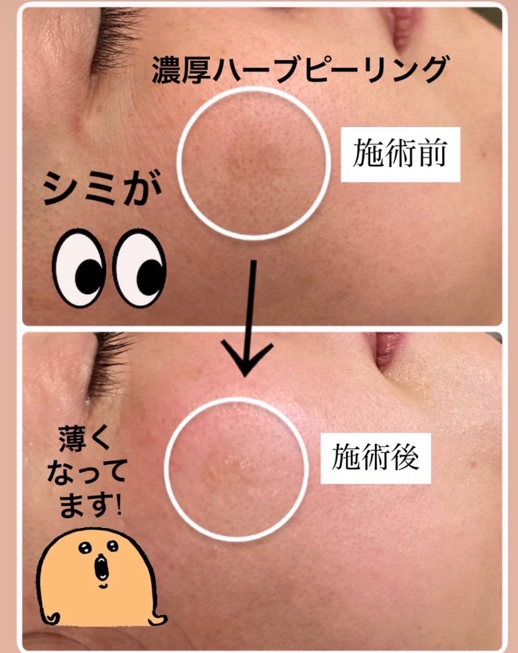 濃いシミにも効果的♪