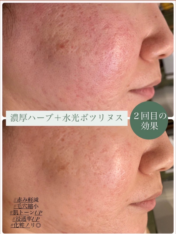 クレーター毛穴でお悩みの方にオススメ◎