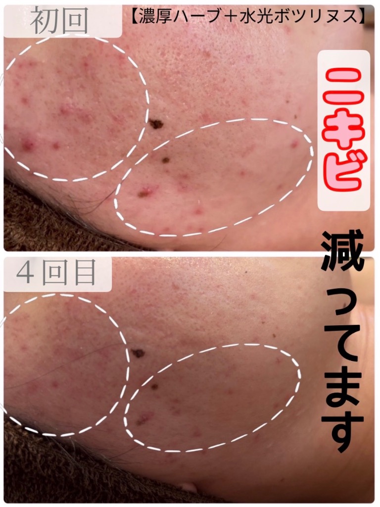 新しいニキビが出来にくいお肌になります◎