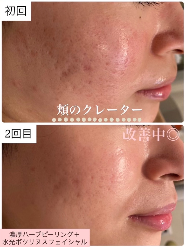 頬のクレーター減ってます✨
