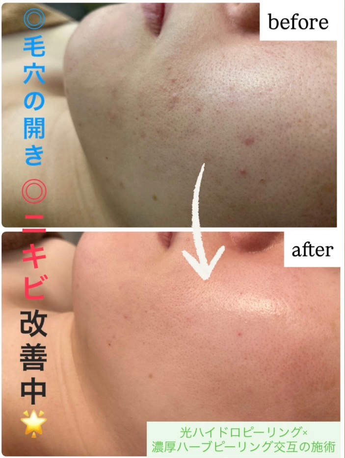 交互の施術で効果UP🌟