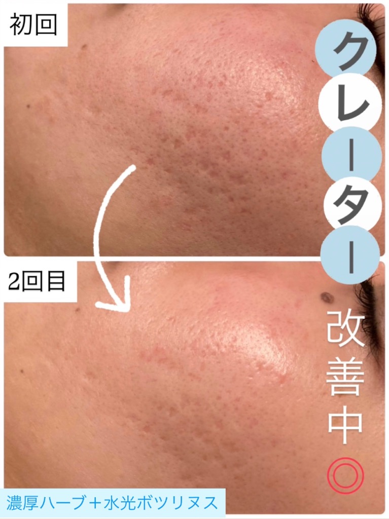 クレーター改善中◎