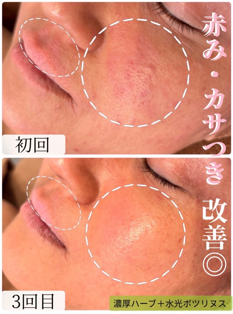 赤み・乾燥でのカサつきも改善◎