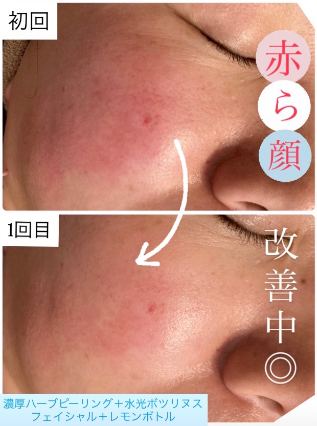 1回目の効果で頬の赤みが薄くなってます✨