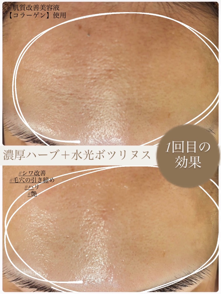 早い肌質改善なら 濃厚ハーブ＋水光ボツリヌス の組み合わせがオススメ◎