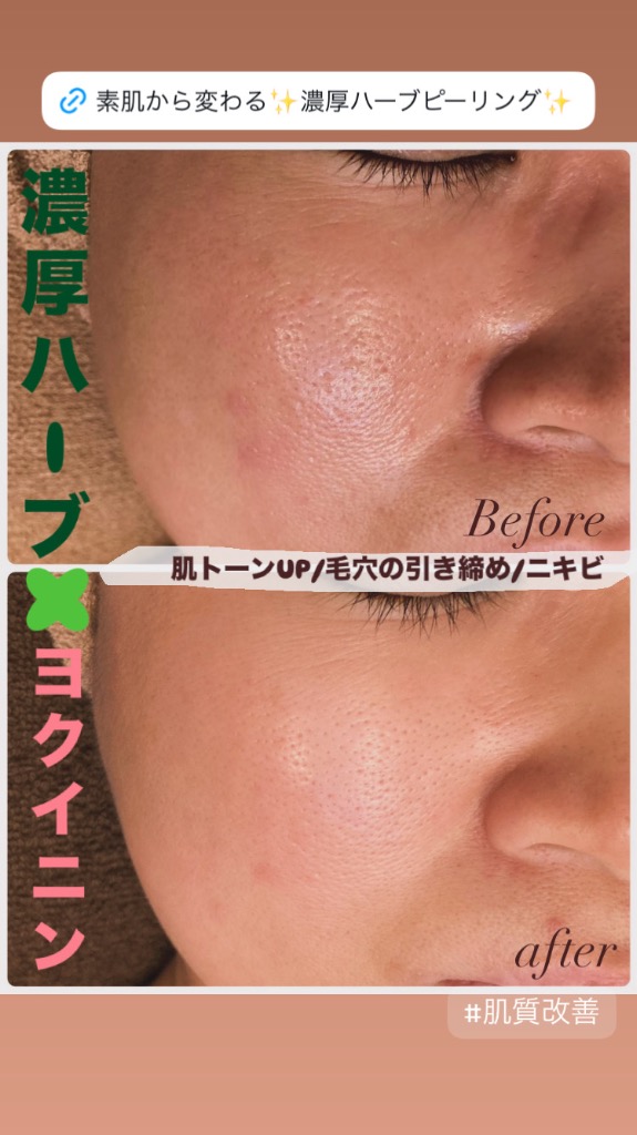 ニキビ/キメ/肌トーンUP