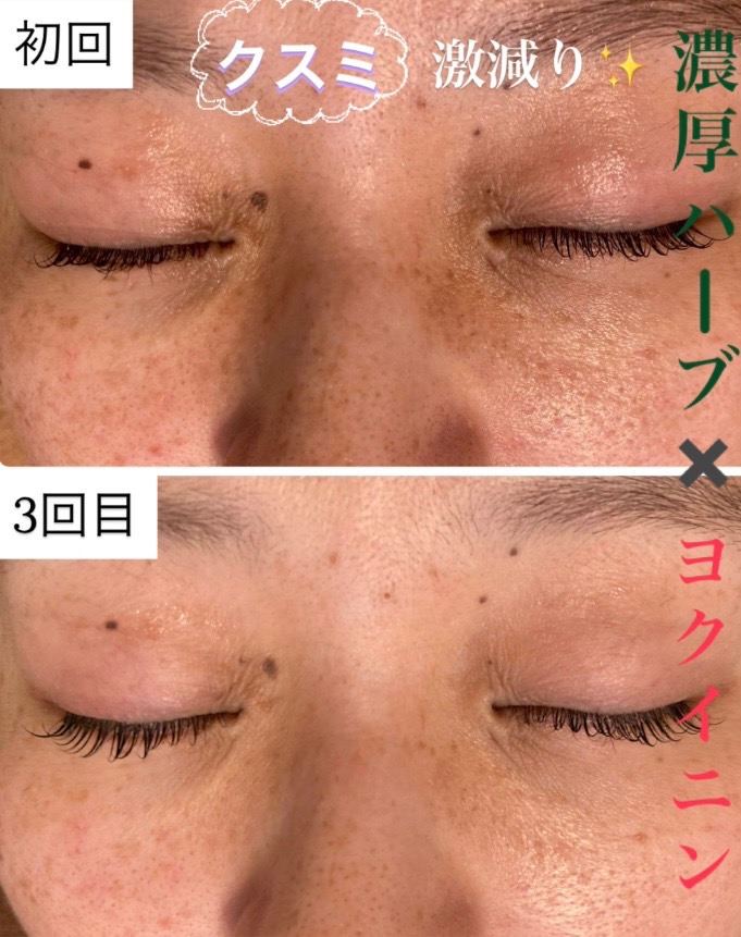 濃厚ハーブピーリング×肌質改善美容液