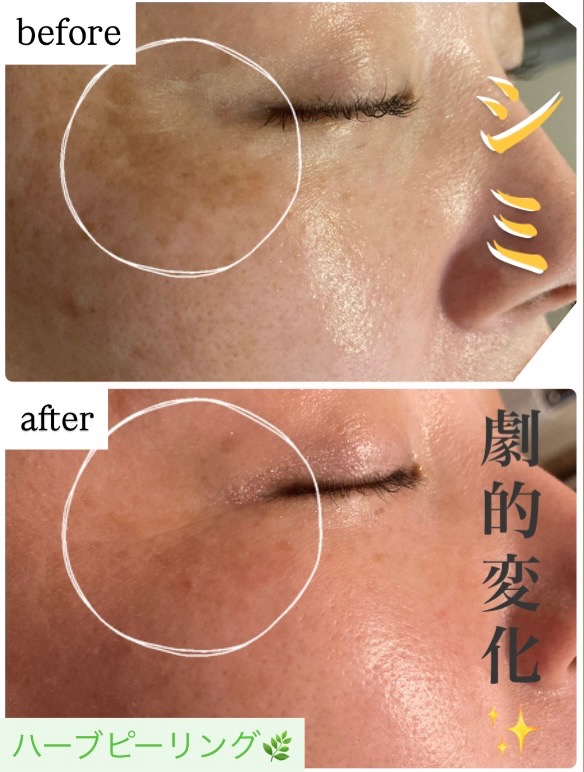 シミ劇的変化😳✨