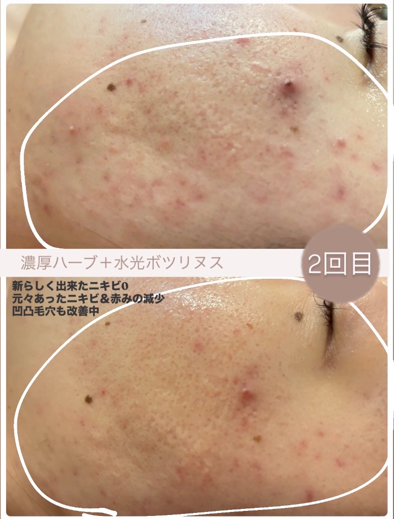 ニキビ/赤み/凹凸毛穴 が同時に改善中◎