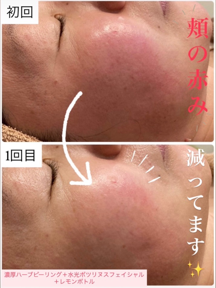赤ら顔も改善◎