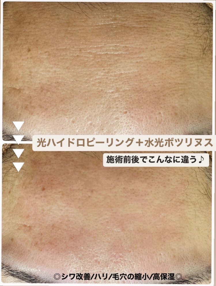 施術前後の効果です✨