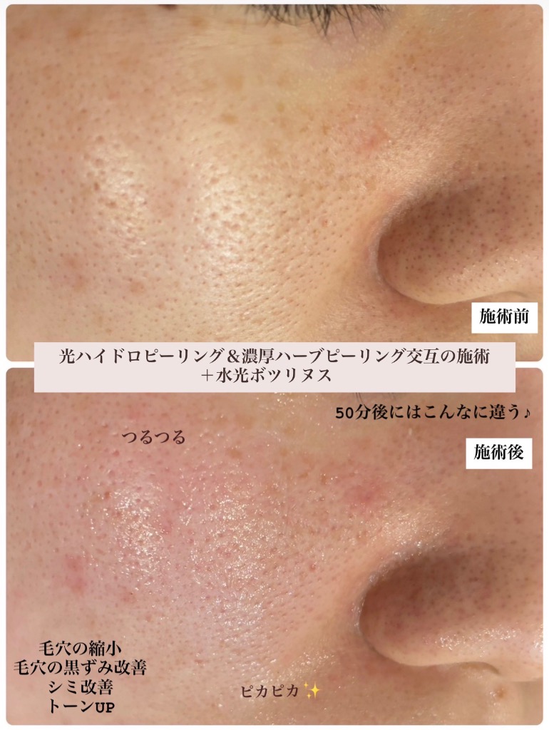 50分後の毛穴の状態✨