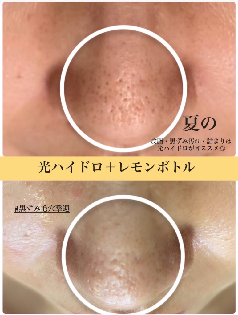 Tゾーンの毛穴/テカり/黒ずみでお悩みの方には 光ハイドロがオススメ◎