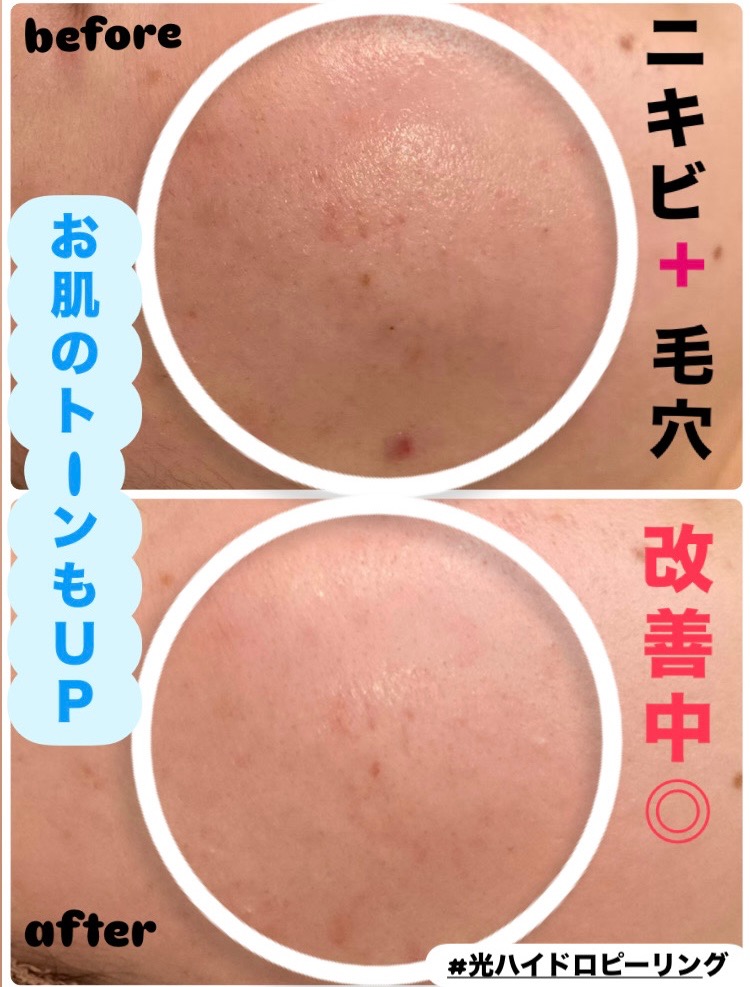 ニキビも毛穴もしっかり改善！