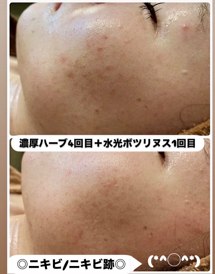 肌のトーンUP、ニキビの軽減◎