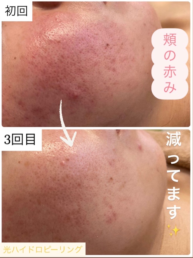 頬の赤み・ニキビ改善中◎