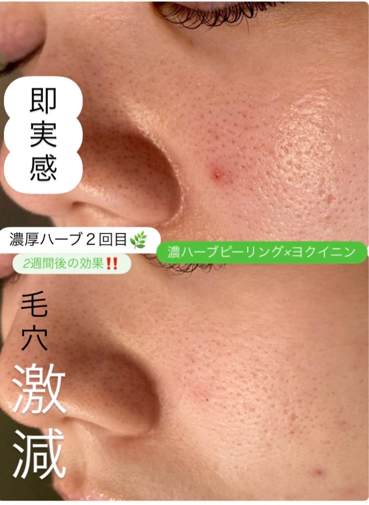 毛穴激減！