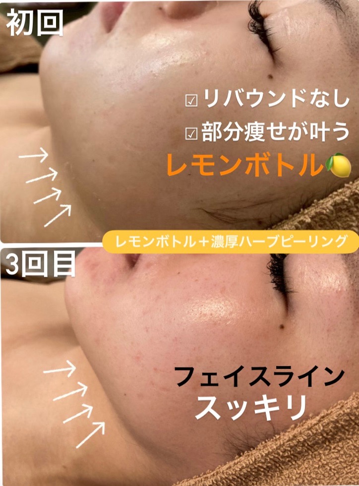 フェイスライン劇的変化！