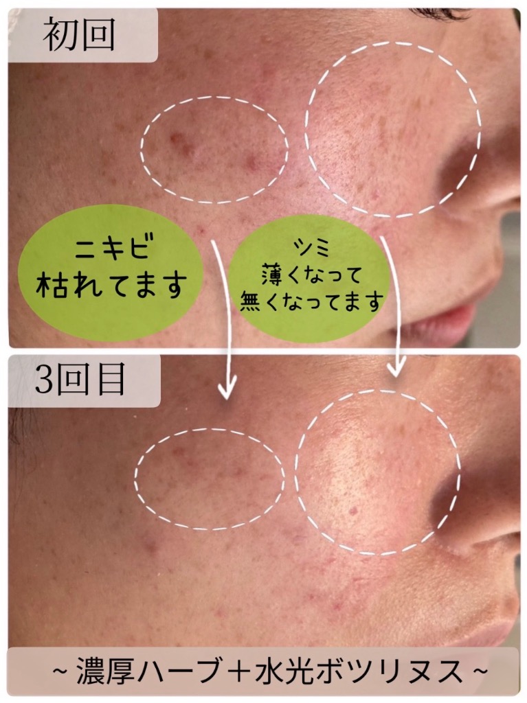 ハーブをすり込むだけで肌質改善◎