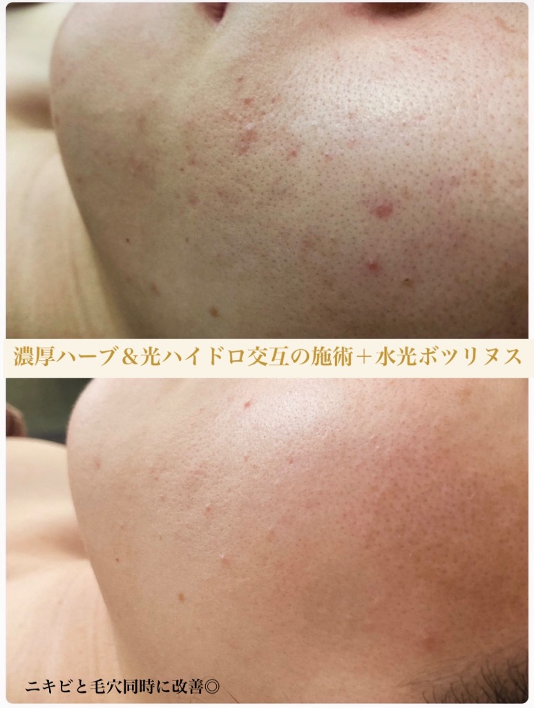 毛穴汚れをスッキリ取ってツルツルサラサラ♪