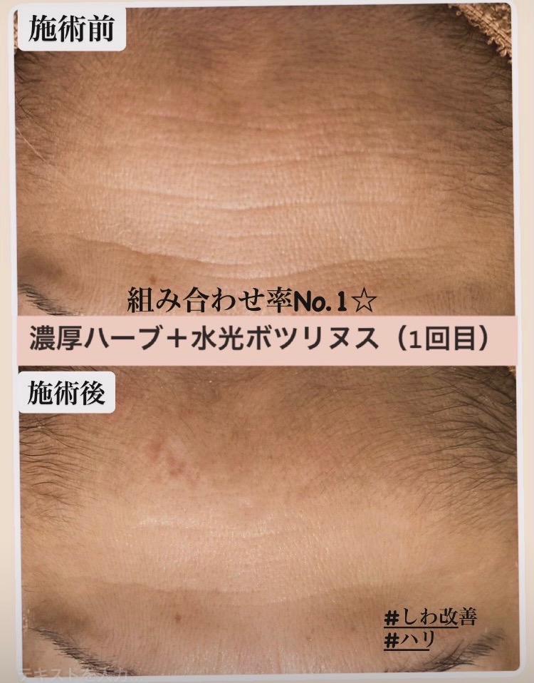 施術前後の1回の効果✨