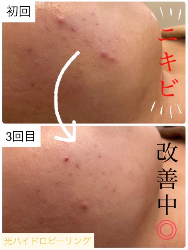 しつこいニキビも枯れます◎