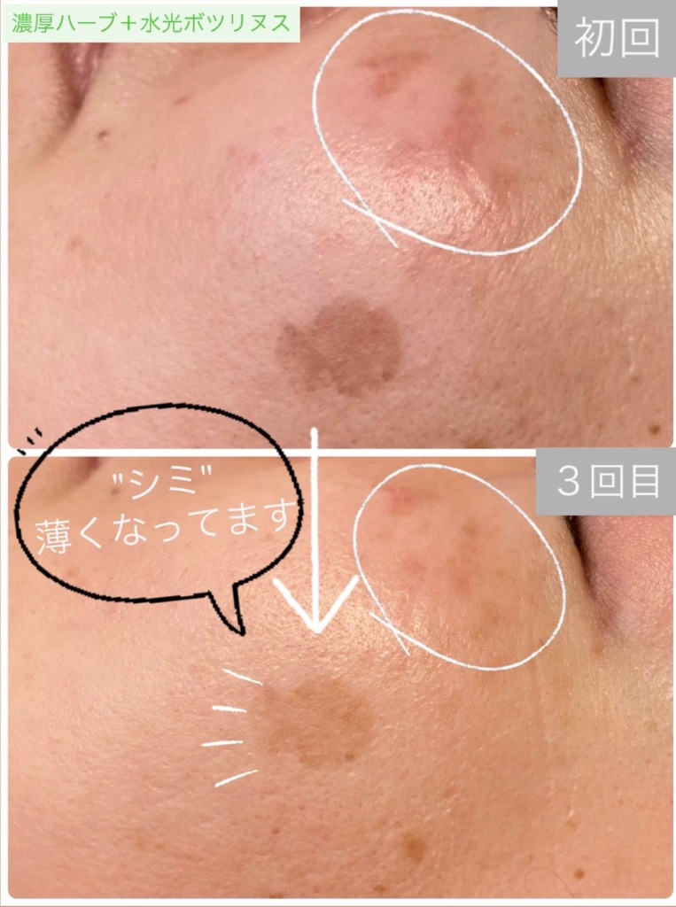 シミ薄くなってます😳✨