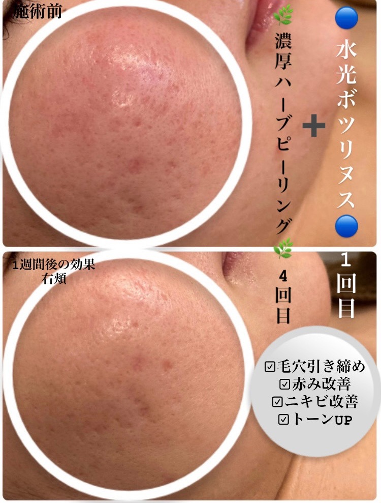 1回で毛穴引き締め実感！